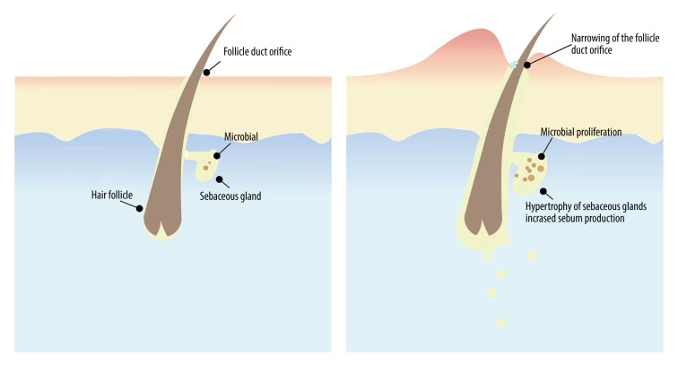 健康皮膚與痘痘皮膚的皮脂腺結構比較圖