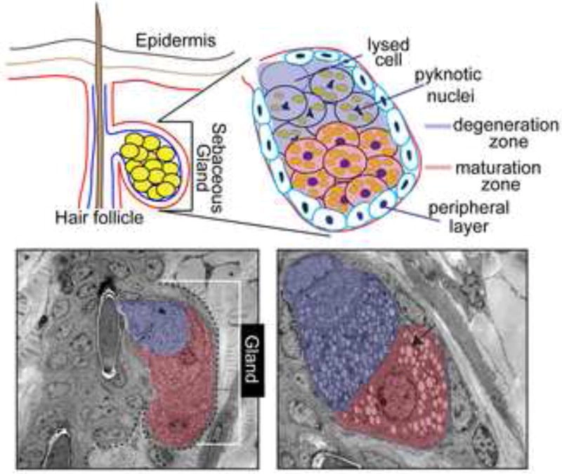 皮脂腺結構示意圖，顯示皮脂細胞從基底層到壞死區的分化過程