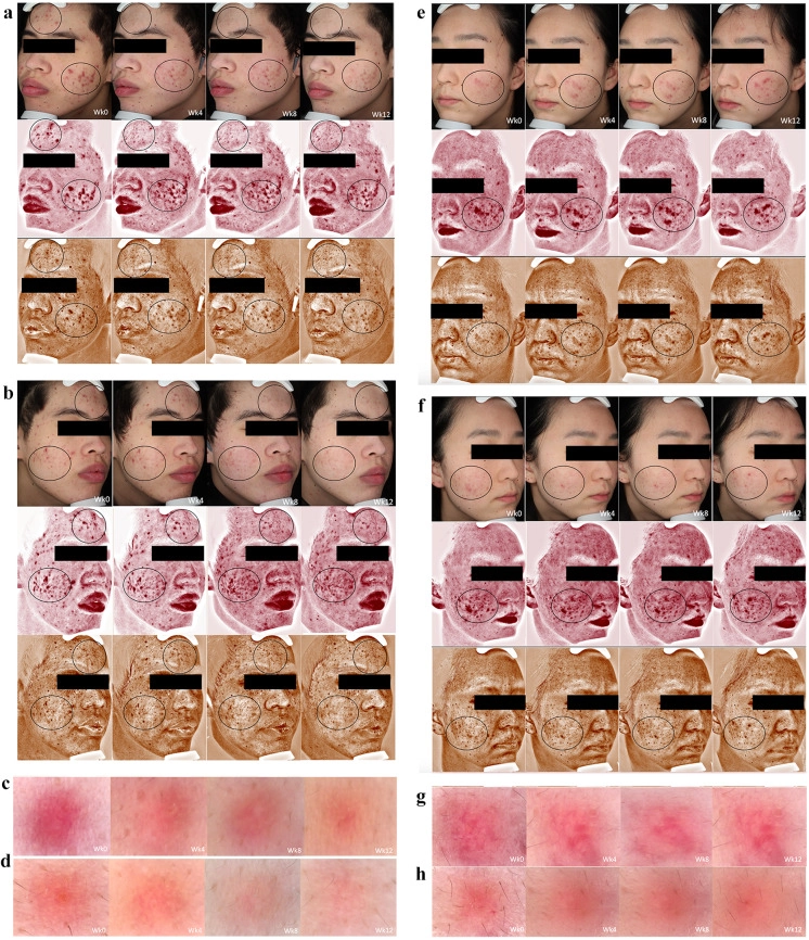 15% 壬二酸凝膠與安慰劑在 VISIA 和皮膚鏡下的臨床對比照片