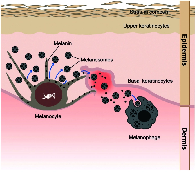 Acne induced post-inflammatory hyperpigmentation model showing melanogenesis pathway