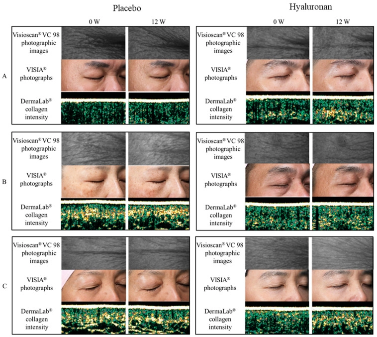 口服玻尿酸 12 週後皮膚微觀結構對比圖，包含 Visioscan 和 VISIA 攝影結果